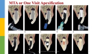 MTA or One Visit Apexification
DR.TINET MARY AUGUSTINE.BDS.MDS 166
 