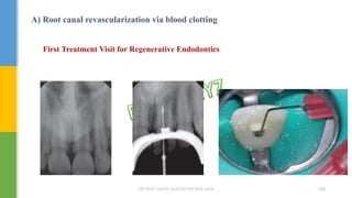 A) Root canal revascularization via blood clotting
First Treatment Visit for Regenerative Endodontics
DR.TINET MARY AUGUSTINE.BDS.MDS 188
 