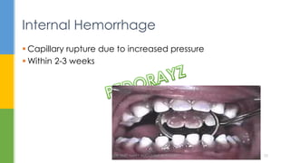 Internal Hemorrhage
 Capillary rupture due to increased pressure
 Within 2-3 weeks
DR.TINET MARY AUGUSTINE.BDS.MDS 20
 