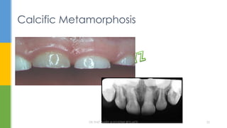 Calcific Metamorphosis
DR.TINET MARY AUGUSTINE.BDS.MDS 22
 