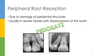 Peripheral Root Resorption
 Due to damage of peridontal structures
 Usually in severe injuries with displacement of the tooth
DR.TINET MARY AUGUSTINE.BDS.MDS 23
 