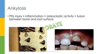 Ankylosis
 PDL injury > inflammation > osteoclastic activity > fusion
between bone and root surface
DR.TINET MARY AUGUSTINE.BDS.MDS 24
 