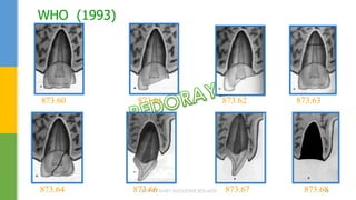 WHO (1993)
873.60 873.61 873.62 873.63
873.64 873.66 873.67 873.68DR.TINET MARY AUGUSTINE.BDS.MDS 48
 
