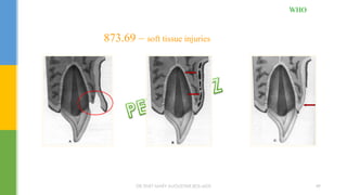 873.69 – soft tissue injuries
WHO
DR.TINET MARY AUGUSTINE.BDS.MDS 49
 