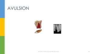 AVULSION
DR.TINET MARY AUGUSTINE.BDS.MDS 68
 