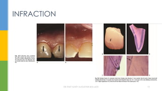 INFRACTION
DR.TINET MARY AUGUSTINE.BDS.MDS 72
 