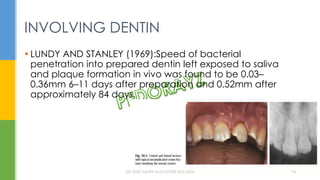  LUNDY AND STANLEY (1969):Speed of bacterial
penetration into prepared dentin left exposed to saliva
and plaque formation in vivo was found to be 0.03–
0.36mm 6–11 days after preparation and 0.52mm after
approximately 84 days.
INVOLVING DENTIN
DR.TINET MARY AUGUSTINE.BDS.MDS 74
 