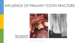 INFLUENCE OF PRIMARY TOOTH FRACTURE
DR.TINET MARY AUGUSTINE.BDS.MDS 75
 