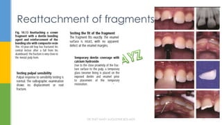 Reattachment of fragments
DR.TINET MARY AUGUSTINE.BDS.MDS 77
 