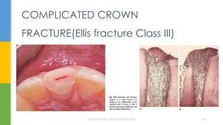 COMPLICATED CROWN
FRACTURE(Ellis fracture Class III)
DR.TINET MARY AUGUSTINE.BDS.MDS 84
 