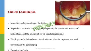 Clinical Examination
 Inspection and exploration of the tooth.
 Inspection - show the size of the pulp exposure, the presence or absence of
hemorrhage, and the amount of crown structure remaining.
 The degree of pulp involvement varies from a pinpoint exposure to a total
unroofing of the coronal pulp
 Experience of pain
DR.TINET MARY AUGUSTINE.BDS.MDS 86
 