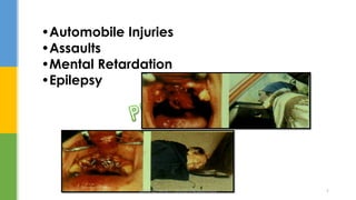 •Automobile Injuries
•Assaults
•Mental Retardation
•Epilepsy
DR.TINET MARY AUGUSTINE.BDS.MDS 9
 