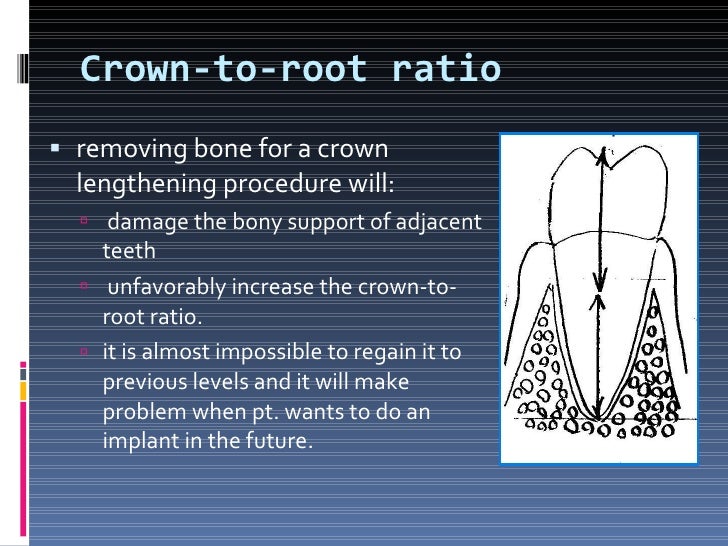 Crown lengthening