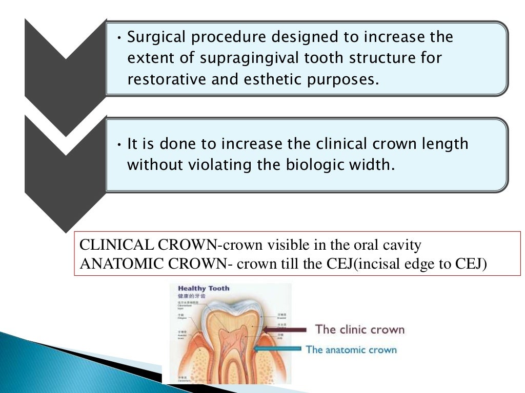 Crown lengthening