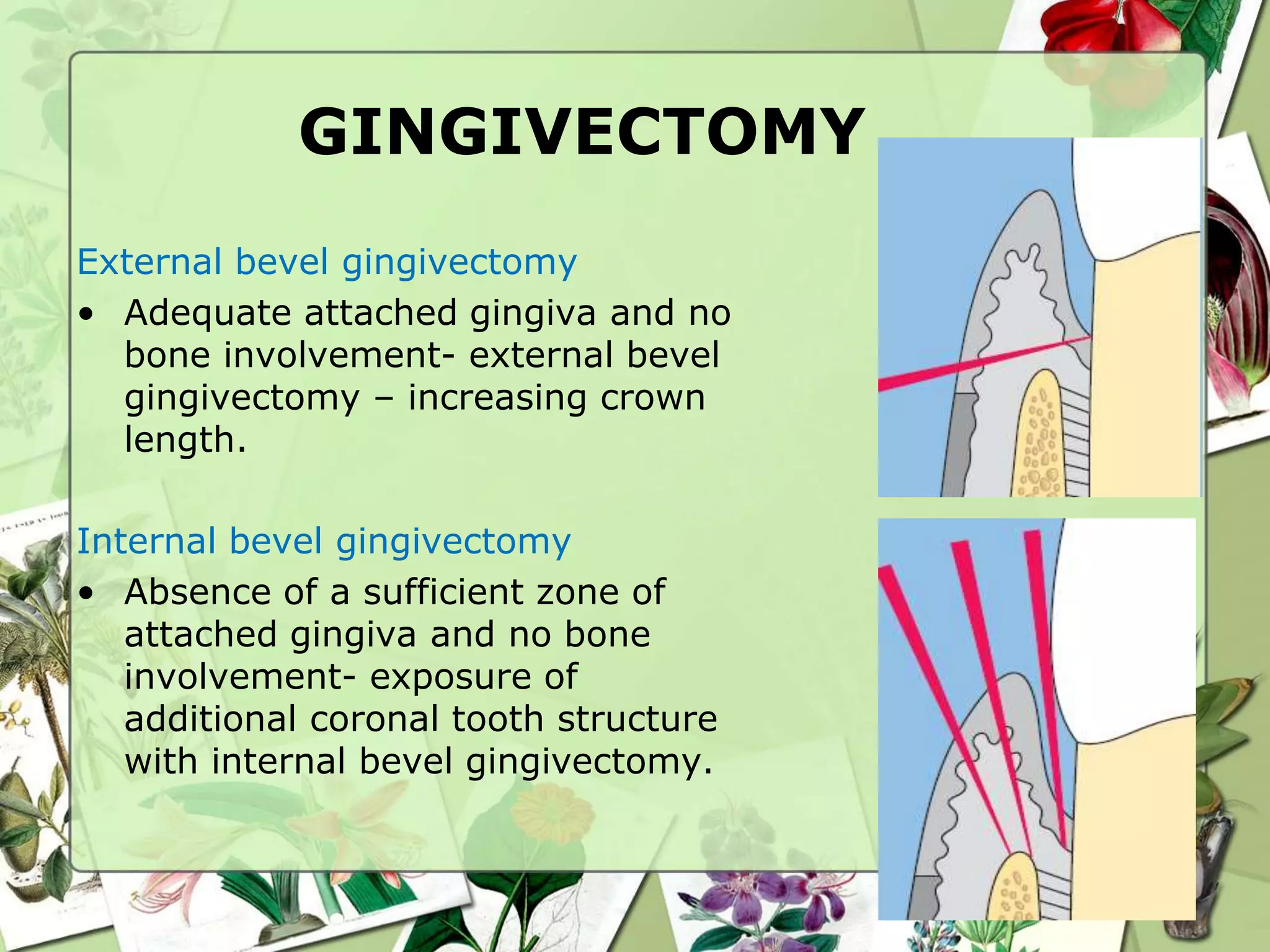 crown lengthening.pptx