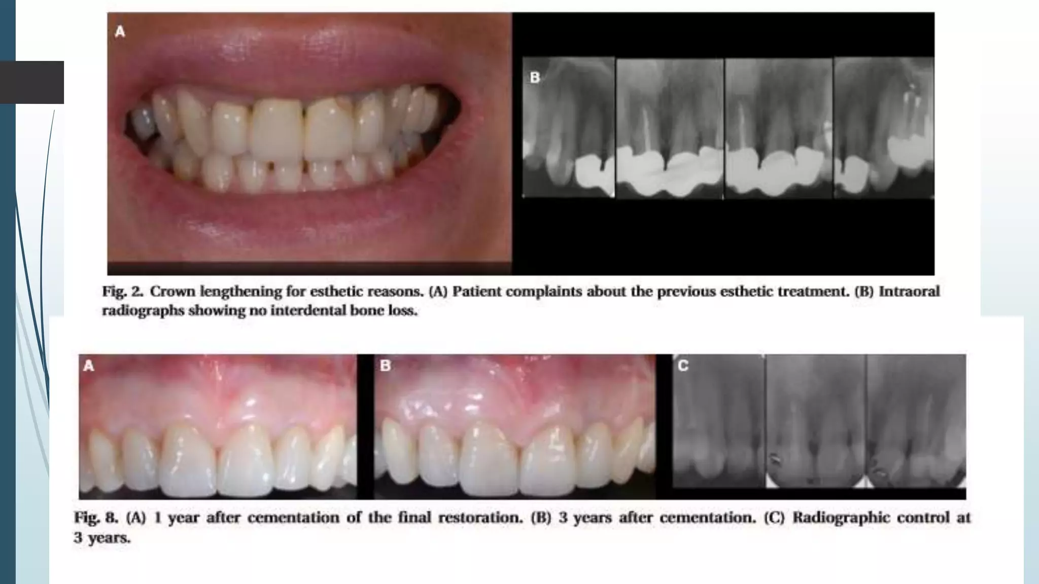 Crown lengthening and restorative procedures in the esthetic zone | PPTX