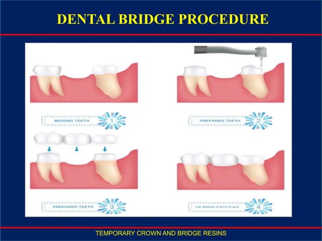 endodontics crown and bridge restoration ppt.pptx