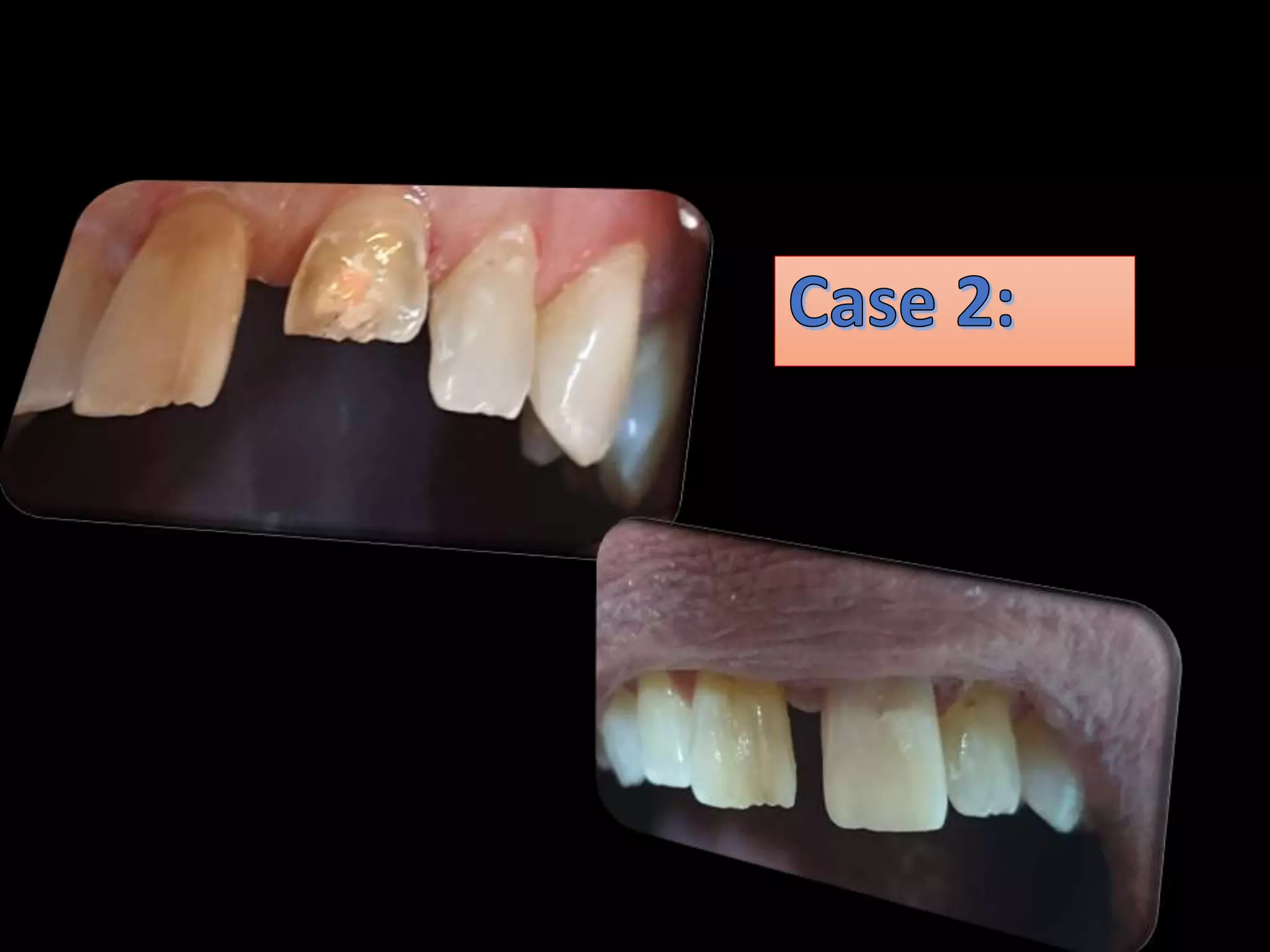 Crown reattachment PPT