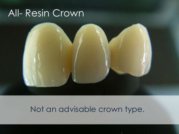 Types of Dental Crowns