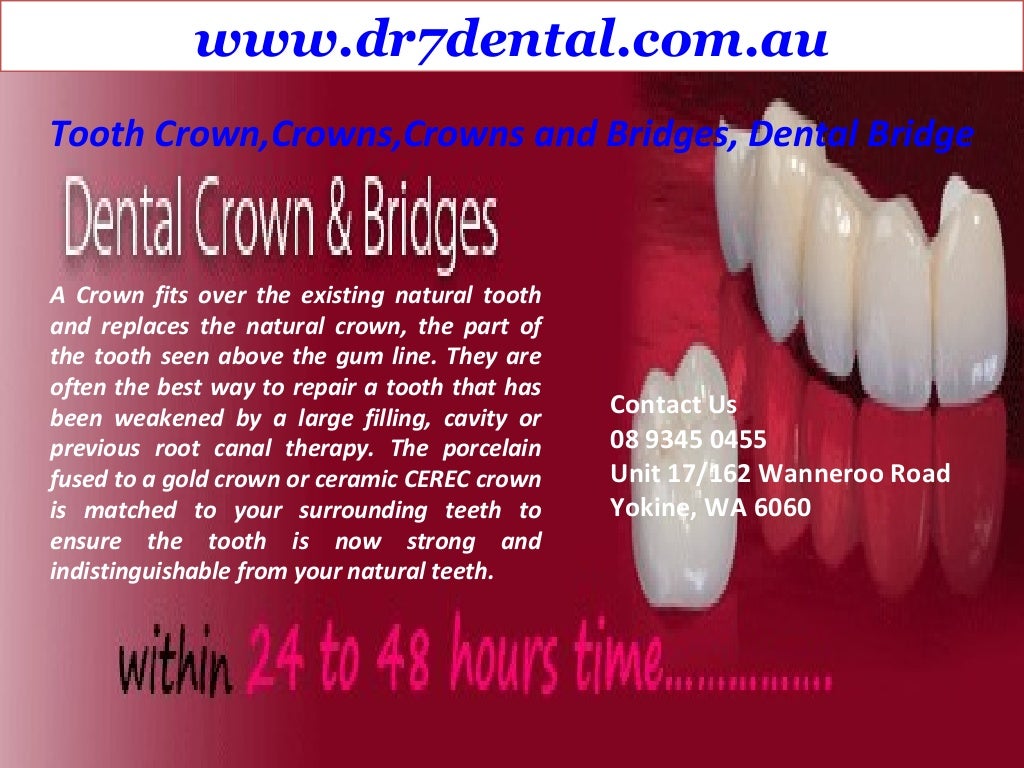 Crowns and bridges
