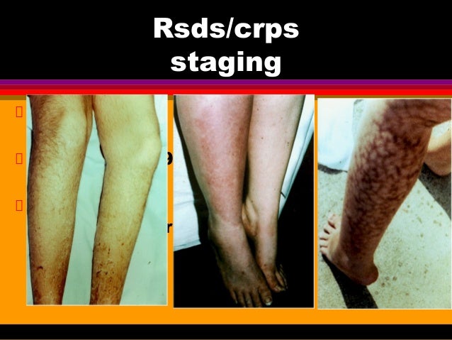 crps pictures