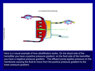 Here is a visual example of how ultrafiltration works. On the blood side of the
hemofilter you have a positive pressure gradient. on the fluid side of the hemofilter
you have a negative pressure gradient. The effluent pump applies pressure on the
membrane causing the fluid to move from the positive pressure gradient to the
lower pressure gradient.
 