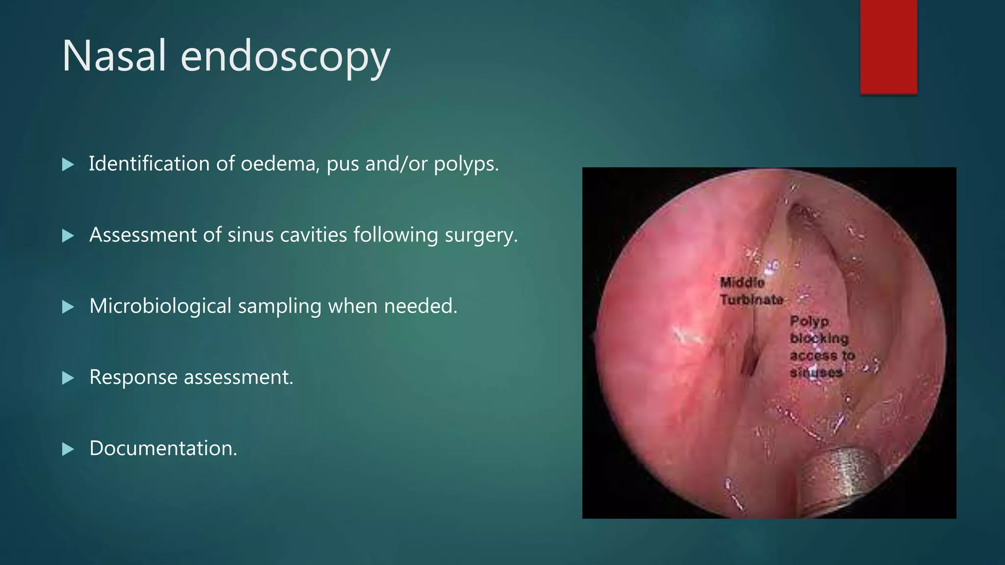 chronic Rhinosinusitis | PPTX