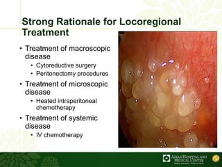 Strong Rationale for Locoregional
Treatment
• Treatment of macroscopic
disease
• Cytoreductive surgery
• Peritonectomy procedures
• Treatment of microscopic
disease
• Heated intraperitoneal
chemotherapy
• Treatment of systemic
disease
• IV chemotherapy
 