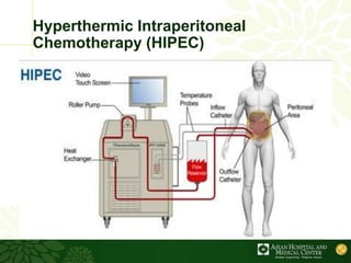 Hyperthermic Intraperitoneal Chemotherapy for Peritoneal Surface ...