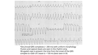 Case Report_Ventriculac Tachycardia_pptx | PPTX