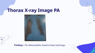 Findings : No abnormalities found in heart and lungs
Thorax X-ray Image PA
 
