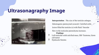 Ultrasonagraphy Image
Interpretation : The size of the testicles enlarges.
Inhomogenic parencymal ecoscult. Calsified solid
lesion filled the testicles (s) with fluid. Vascular
flow in the testicular parenchyma increases.
Findings:
 Left testicular solid calcified mass, DD/ Teratoma, Germ
cell tumor
 Hydrocele Sinistra
 