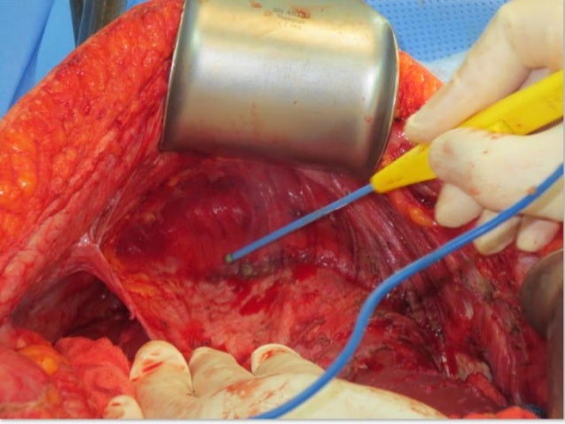 Mets Day 1055 Second Optivo infusion