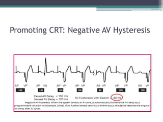 Promoting CRT: Negative AV Hysteresis
 