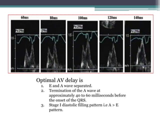 Optimal AV delay is
1. E and A wave separated.
2. Termination of the A wave at
approximately 40 to 60 milliseconds before
the onset of the QRS.
3. Stage I diastolic filling pattern i.e A > E
pattern.
 