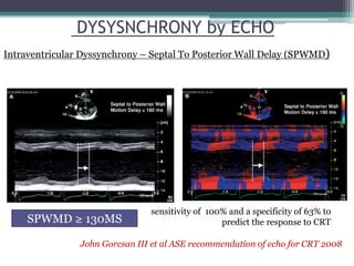 DYSYSNCHRONY by ECHO
Intraventricular Dyssynchrony – Septal To Posterior Wall Delay (SPWMD)
John Gorcsan III et al ASE recommendation of echo for CRT 2008
SPWMD ≥ 130MS
sensitivity of 100% and a specificity of 63% to
predict the response to CRT
 