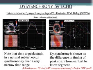 Note that time to peak strain
in a normal subject occur
synchronously over a very
narrow time range.
Dyssynchrony is shown as
the difference in timing of
peak strain from earliest to
latest segment
DYSYSNCHRONY by ECHO
Intraventricular Dyssynchrony – Septal To Posterior Wall Delay (SPWD)
John Gorcsan III et al ASE recommendation of echo for CRT 2008
 