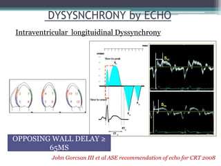 DYSYSNCHRONY by ECHO
Intraventricular longituidinal Dyssynchrony
John Gorcsan III et al ASE recommendation of echo for CRT 2008
OPPOSING WALL DELAY ≥
65MS
 