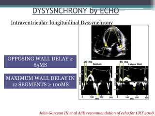 DYSYSNCHRONY by ECHO
Intraventricular longituidinal Dyssynchrony
John Gorcsan III et al ASE recommendation of echo for CRT 2008
OPPOSING WALL DELAY ≥
65MS
MAXIMUM WALL DELAY IN
12 SEGMENTS ≥ 100MS
 