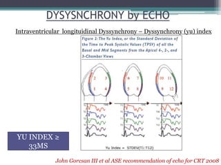 DYSYSNCHRONY by ECHO
Intraventricular longituidinal Dyssynchrony – Dyssynchrony (yu) index
John Gorcsan III et al ASE recommendation of echo for CRT 2008
YU INDEX ≥
33MS
 