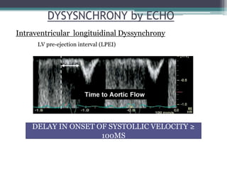 DYSYSNCHRONY by ECHO
Intraventricular longituidinal Dyssynchrony
DELAY IN ONSET OF SYSTOLLIC VELOCITY ≥
100MS
LV pre-ejection interval (LPEI)
 