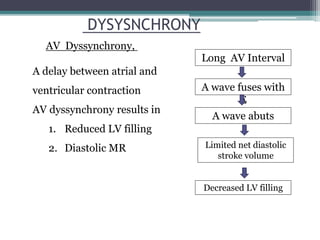 DYSYSNCHRONY
AV Dyssynchrony,
Long AV Interval
A wave fuses with
E
A wave abuts
Limited net diastolic
stroke volume
Decreased LV filling
A delay between atrial and
ventricular contraction
AV dyssynchrony results in
1. Reduced LV filling
2. Diastolic MR
 