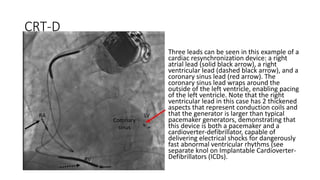 CRT-D
Three leads can be seen in this example of a
cardiac resynchronization device: a right
atrial lead (solid black arrow), a right
ventricular lead (dashed black arrow), and a
coronary sinus lead (red arrow). The
coronary sinus lead wraps around the
outside of the left ventricle, enabling pacing
of the left ventricle. Note that the right
ventricular lead in this case has 2 thickened
aspects that represent conduction coils and
that the generator is larger than typical
pacemaker generators, demonstrating that
this device is both a pacemaker and a
cardioverter-defibrillator, capable of
delivering electrical shocks for dangerously
fast abnormal ventricular rhythms (see
separate knol on Implantable Cardioverter-
Defibrillators (ICDs).
RA
RV
LV
Coronary
sinus
 