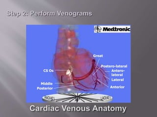 CS Os
Middle
Posterior
Postero-lateral
Great
Lateral
Antero-
lateral
Anterior
Step 2: Perform Venograms
 