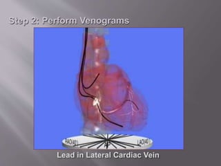 Step 2: Perform Venograms
 
