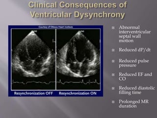  Abnormal
interventricular
septal wall
motion
 Reduced dP/dt
 Reduced pulse
pressure
 Reduced EF and
CO
 Reduced diastolic
filling time
 Prolonged MR
duration
 