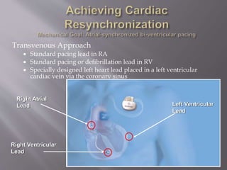 Transvenous Approach
 Standard pacing lead in RA
 Standard pacing or defibrillation lead in RV
 Specially designed left heart lead placed in a left ventricular
cardiac vein via the coronary sinus
Right Atrial
Lead
Right Ventricular
Lead
Left Ventricular
Lead
 