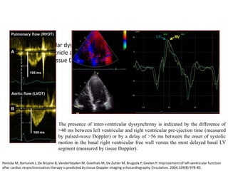 • Interventricular dyssynchrony refers to dyssynchrony between the left and
the right ventricle and can be measured using conventional pulsed-wave
Doppler or Tissue Doppler imaging
The presence of inter-ventricular dyssynchrony is indicated by the difference of
>40 ms between left ventricular and right ventricular pre-ejection time (measured
by pulsed-wave Doppler) or by a delay of >56 ms between the onset of systolic
motion in the basal right ventricular free wall versus the most delayed basal LV
segment (measured by tissue Doppler).
Penicka M, Bartunek J, De Bruyne B, Vanderheyden M, Goethals M, De Zutter M, Brugada P, Geelen P. Improvement of left ventricular function
after cardiac resynchronization therapy is predicted by tissue Doppler imaging echocardiography. Circulation. 2004;109(8):978-83.
 
