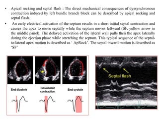 • Apical rocking and septal flash : The direct mechanical consequences of dyssynchronous
contraction induced by left bundle branch block can be described by apical rocking and
septal flash.
• An early electrical activation of the septum results in a short initial septal contraction and
causes the apex to move septally while the septum moves leftward (SF, yellow arrow in
the middle panel). The delayed activation of the lateral wall pulls then the apex laterally
during the ejection phase while stretching the septum. This typical sequence of the septal-
to-lateral apex motion is described as ‘ ApRock’. The septal inward motion is described as
‘SF’
 