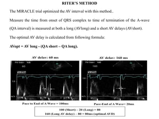 RITER’S METHOD
The MIRACLE trial optimized the AV interval with this method..
Measure the time from onset of QRS complex to time of termination of the A-wave
(QA interval) is measured at both a long (AVlong) and a short AV delays (AVshort).
The optimal AV delay is calculated from following formula:
AVopt = AV long - (QA short – QA long).
 